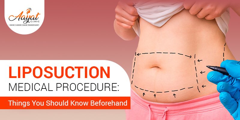 Liposuction